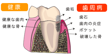 歯周病
